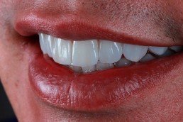 institutobernal-dr-anderson-bernal-tratamentos-lentes-de-contato-dentais-2019